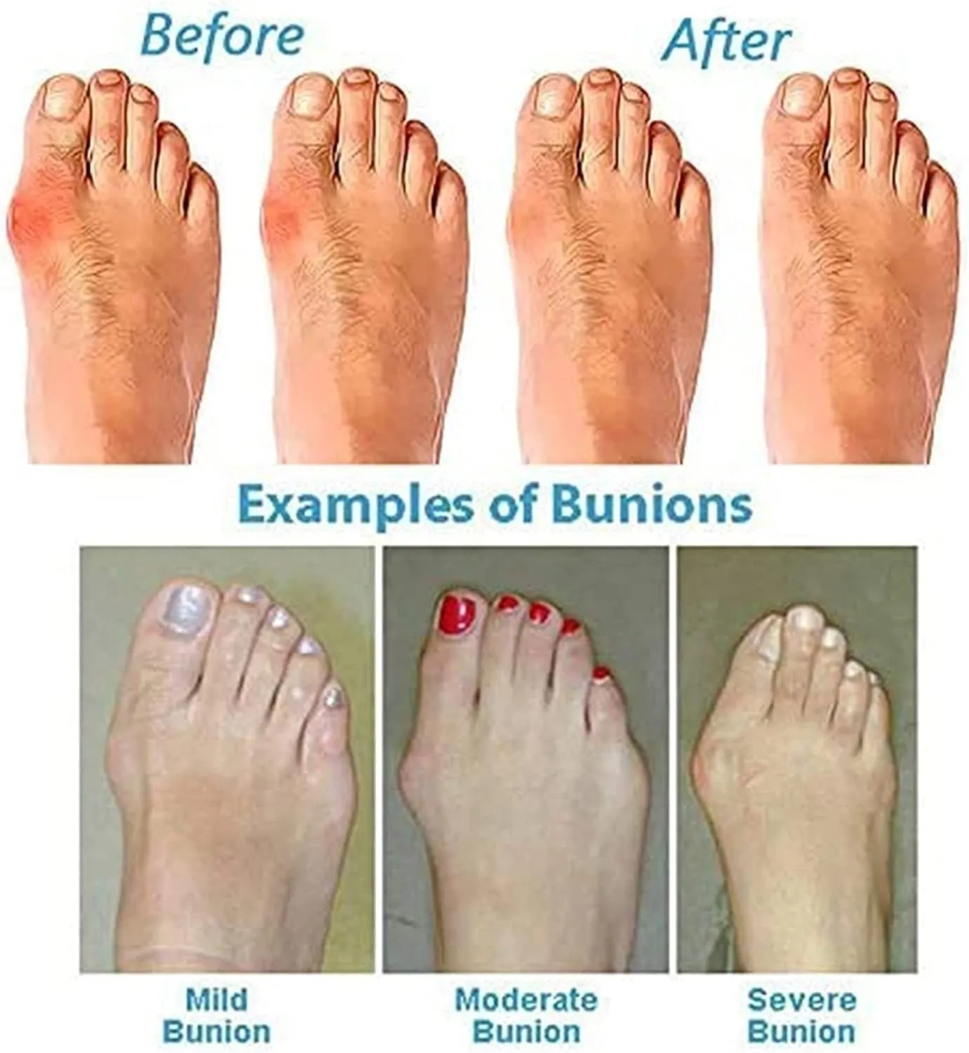 Breathable Bunion Corrector Sandals Men, Summer Lightweight Men's Sandals Bunion Relief(Black,8)